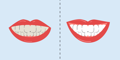 teeth whitening before and after