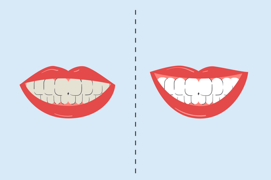 teeth whitening before and after