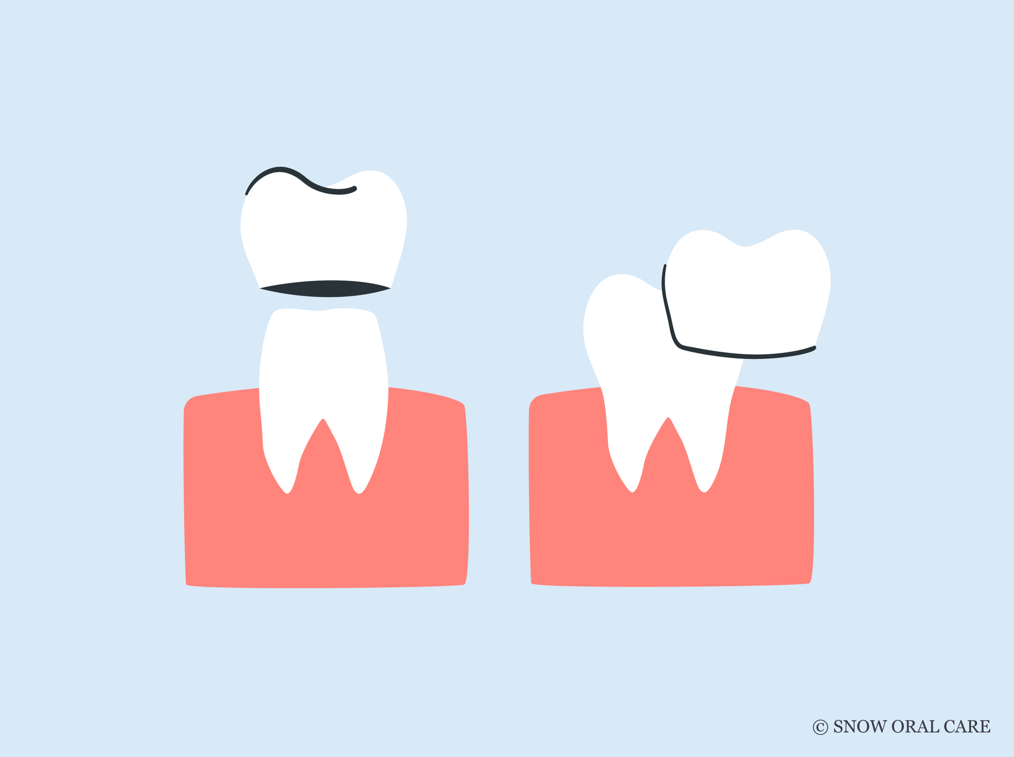teeth whitening for crowns and veneers 