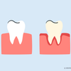 teeth whitening for periodontal disease 