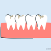 teeth whitening with cavities 