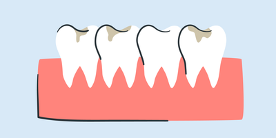teeth whitening with cavities 