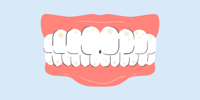 tooth stain vs cavity 