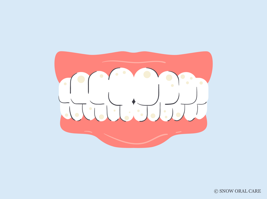 tooth stain vs cavity 