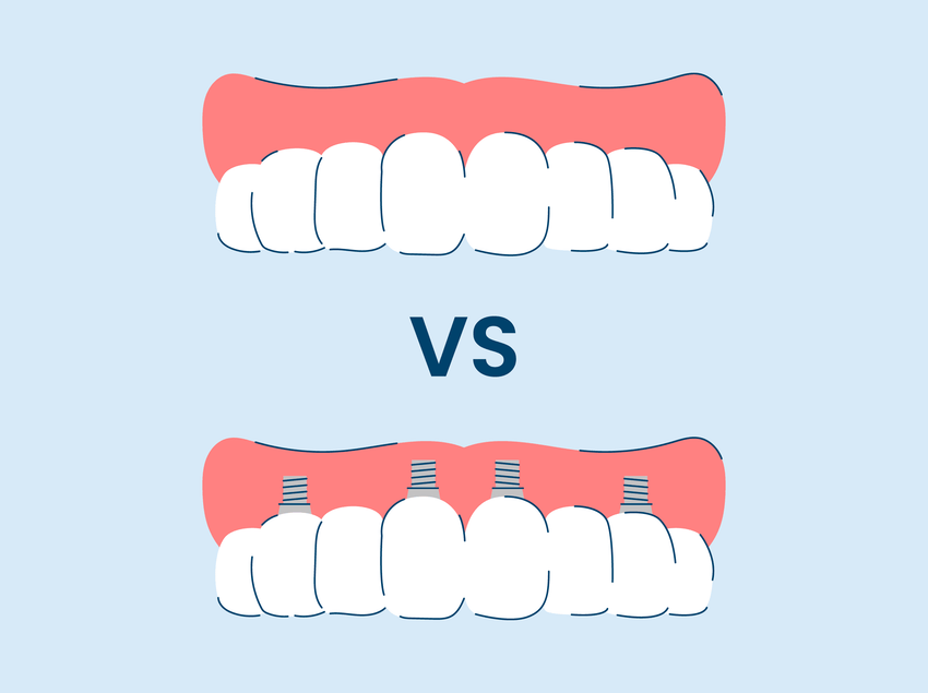 implant supported dentures