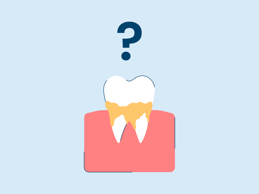 Calcium Deposits on Teeth: Everything You Need To Know [Updated 2026]