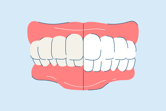 What Is An Overbite and How Can Overbite Teeth Be Fixed?