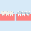 what is teeth whitening