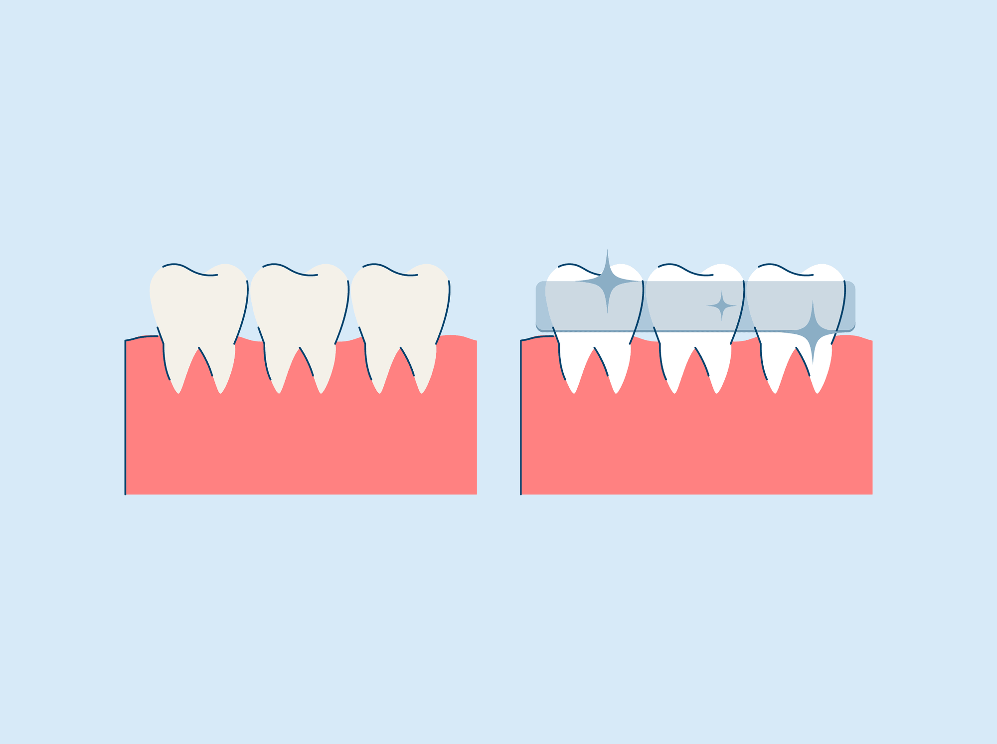 what is teeth whitening