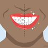 white spots on teeth after braces 
