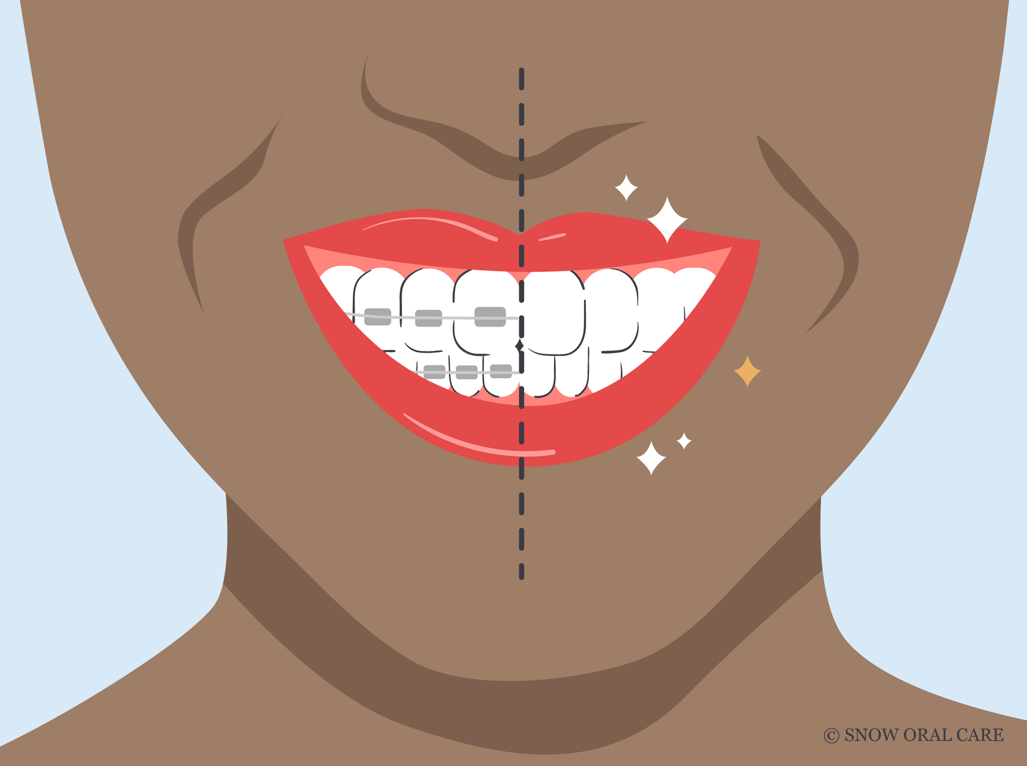 white spots on teeth after braces 