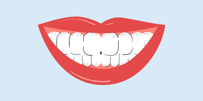 white spots on teeth near gums 
