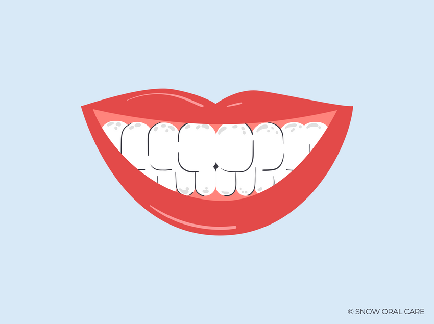 white spots on teeth near gums 