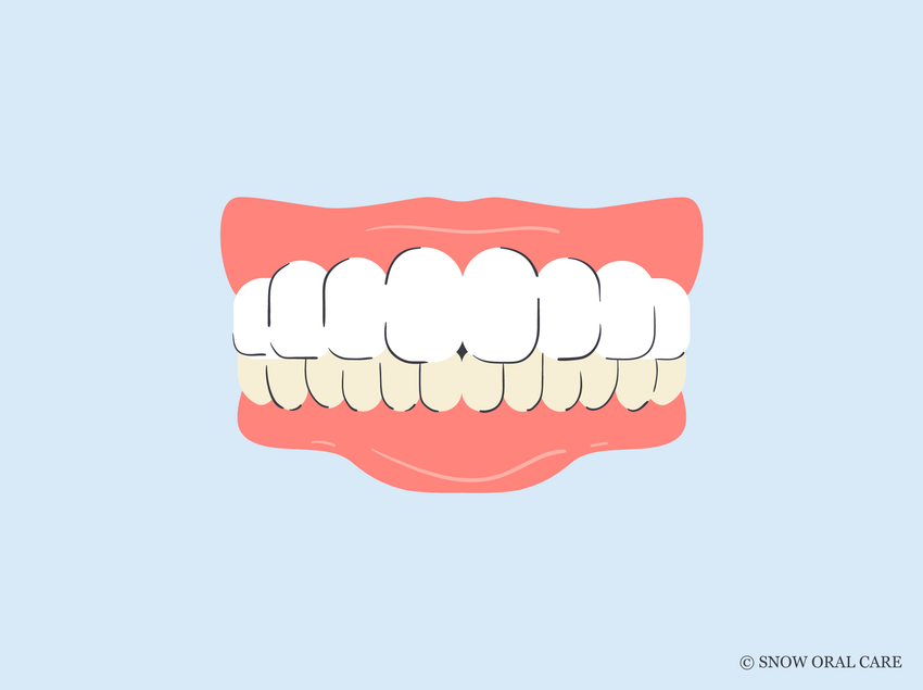 why are my bottom teeth more yellow 