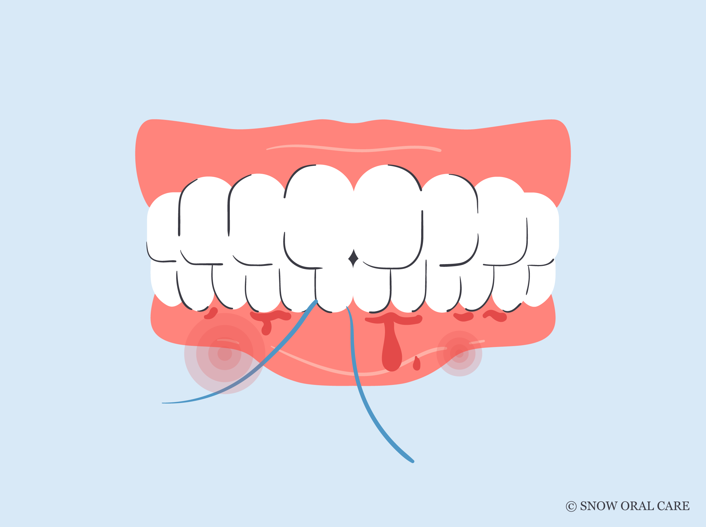 Why Do My Gums Bleed When I Floss? SNOW® Oral Care