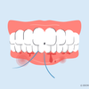 why do my gums bleed when i floss