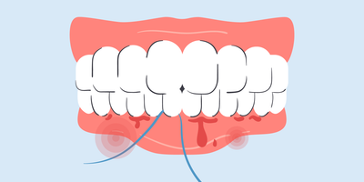 why do my gums bleed when i floss
