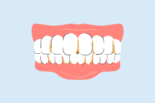 yellow stains in between teeth 