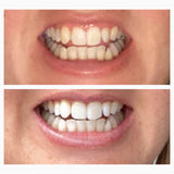 Whitening Serum Starter Kit | Purple Teeth Serum | SNOW® Oral Care