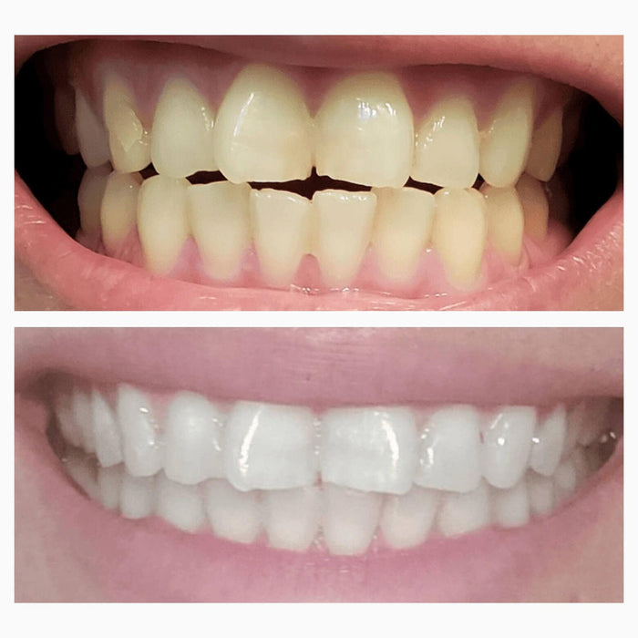 LED Teeth Whitening Mouthpiece |Teeth Whitening LED | SNOW® Oral Care