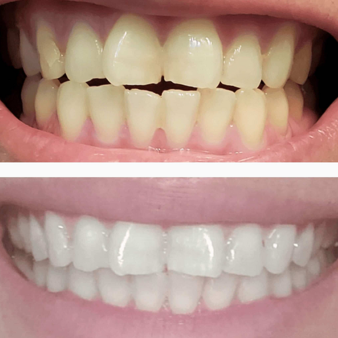 Diamond Teeth Whitening Kit - Limited Offer - SNOW® Oral Care