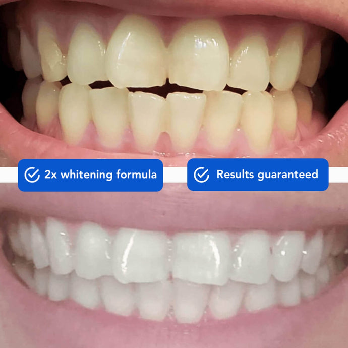 Diamond Wireless Teeth Whitening Kit - SNOW® Oral Care