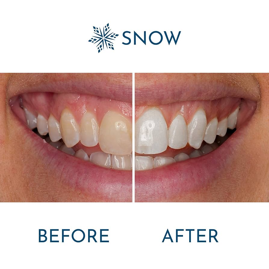 Visible whitening results using Snow – close-up of smile before and after treatment
