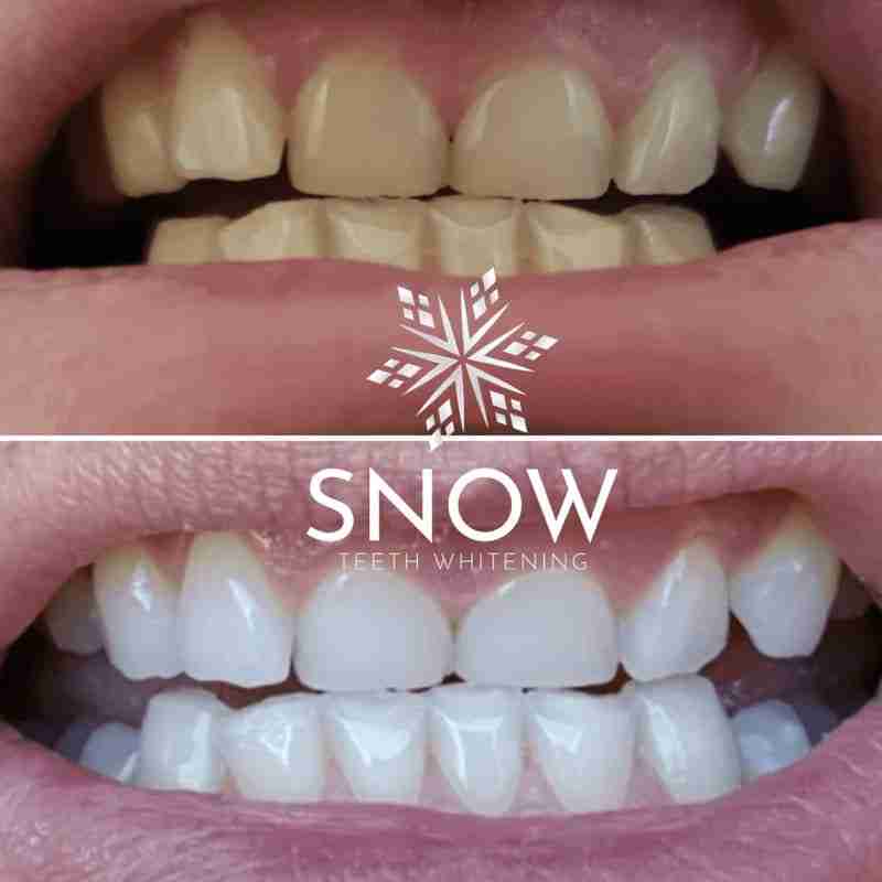 Dramatic results from Snow Gold Whitening Pen – yellow teeth visibly whitened