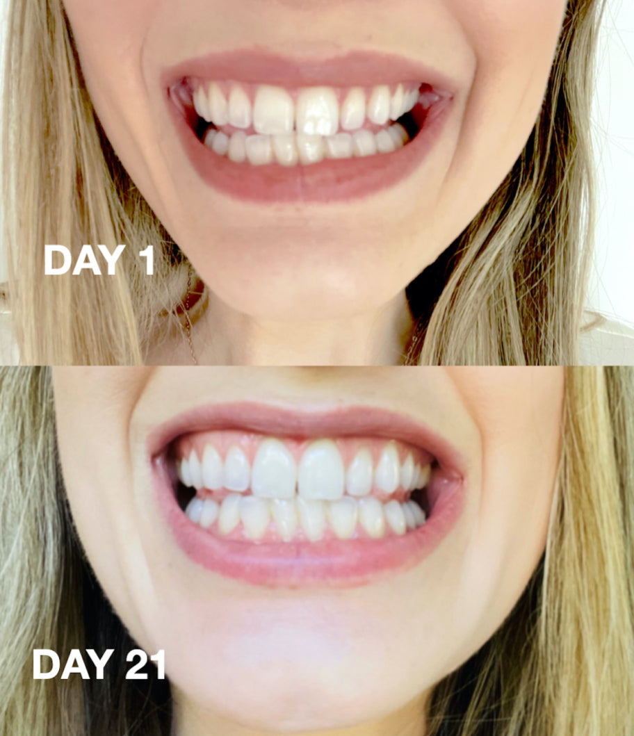 Before and after results of Snow Whitening Pen – whiter teeth after 21 days of at-home us