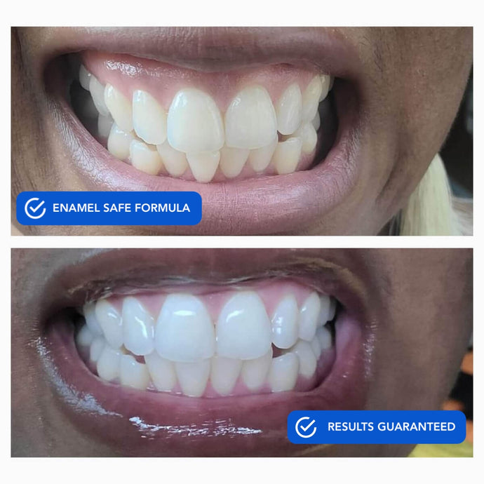 Dissolving Teeth Whitening Strips | Teeth Strips | SNOW® Oral Care