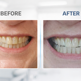 Extra-Strength Teeth Whitening Serum Pen (3-Pack) | SNOW® Gold Dual-Peroxide