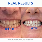 Diamond Wireless Teeth Whitening Kit - SNOW® Oral Care